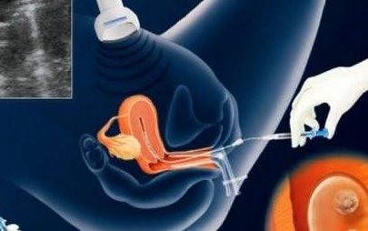 2026北京大学深圳医院试管成功率解读，附试管助孕费用清单